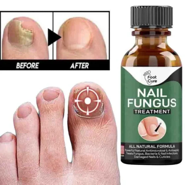 Anti-Fungal Nail Repair Serum – Fast Nail Fungus Treatment & Nail Restoration Gel