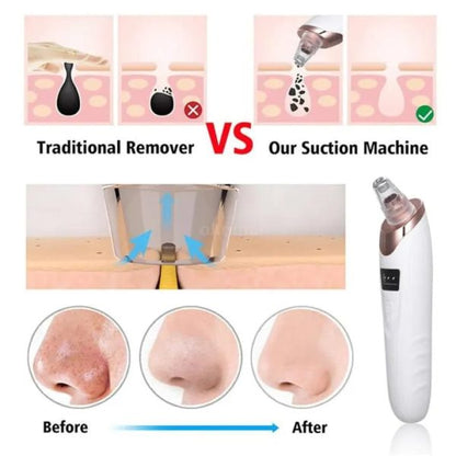 4-in-1 Rechargeable Blackhead Remover: Vacuum, Pore Cleaner, Extractor