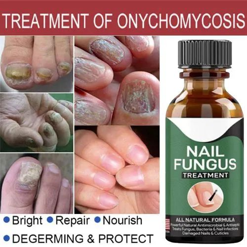 Anti-Fungal Nail Repair Serum – Fast Nail Fungus Treatment & Nail Restoration Gel